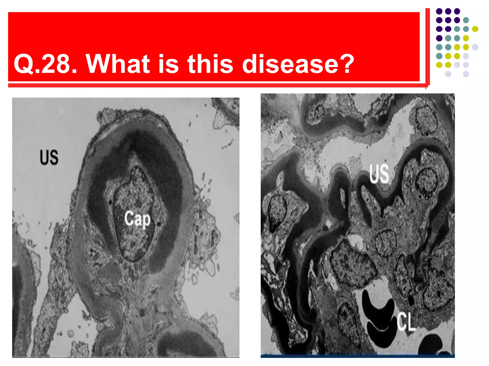 Q.28. What is this disease?
 