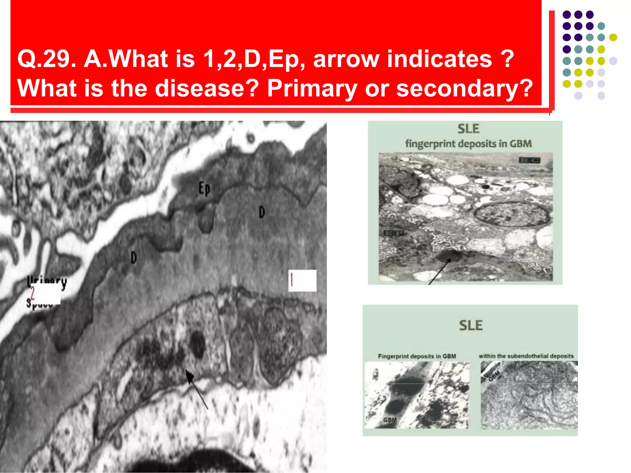 Q.29. A.What is 1,2,D,Ep, arrow indicates ?
What is the disease? Primary or secondary?
 