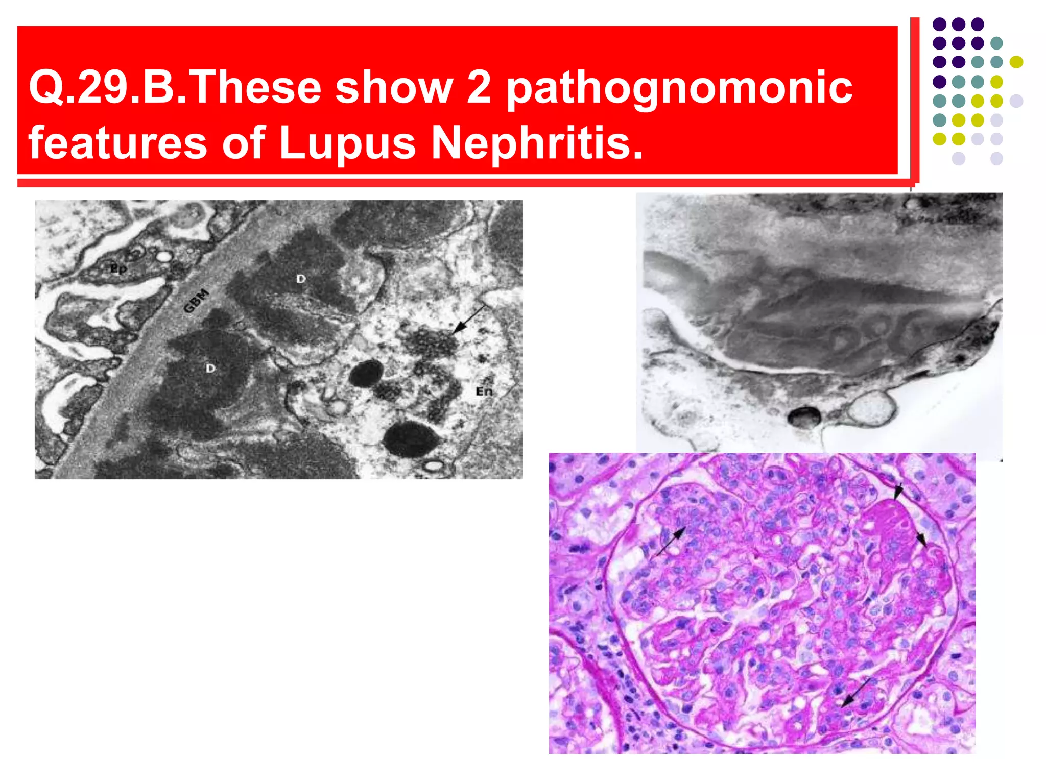 Q.29.B.These show 2 pathognomonic
features of Lupus Nephritis.
 