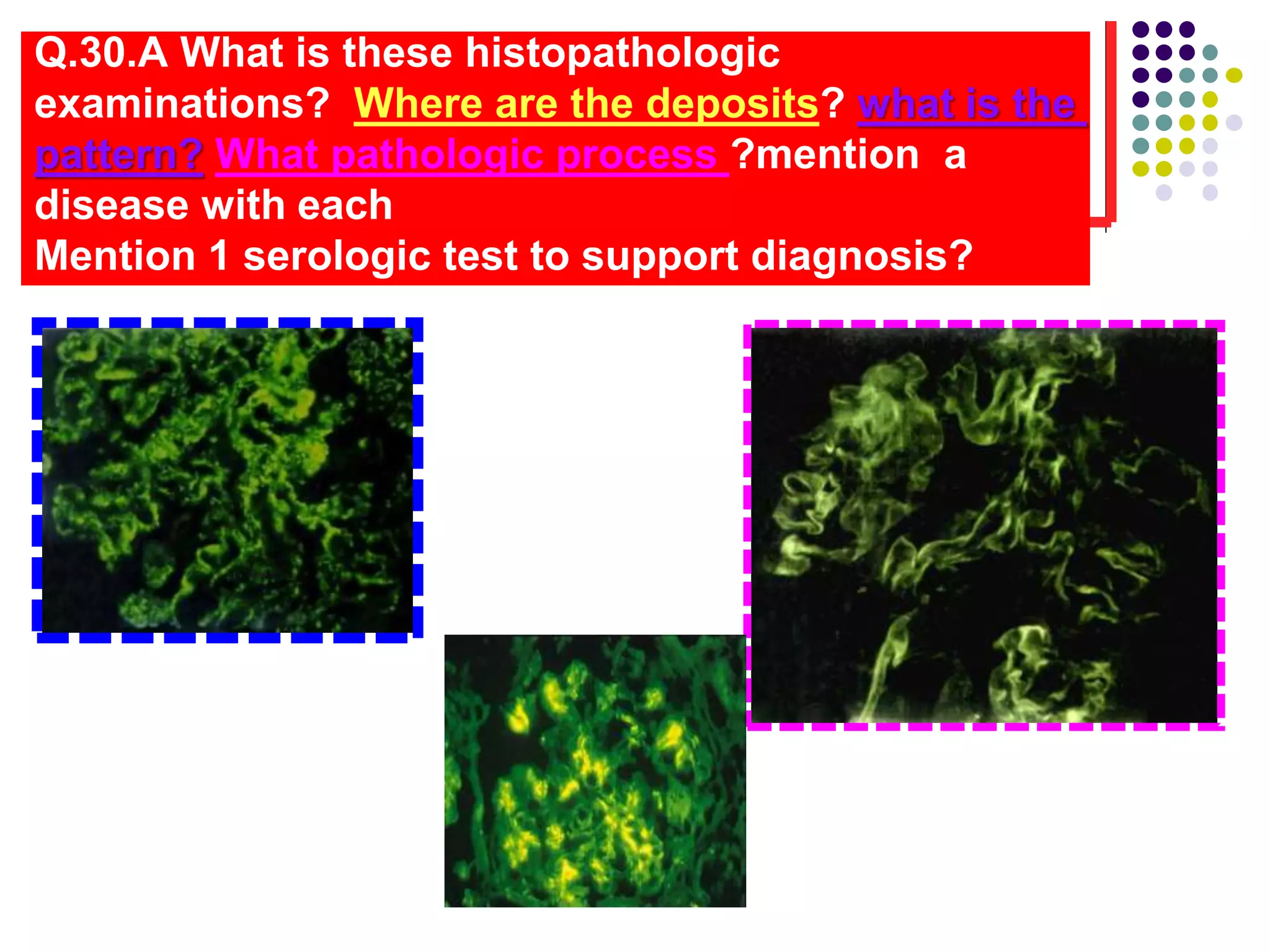 Q.30.A What is these histopathologic
examinations? Where are the deposits? what is the
pattern? What pathologic process ?mention a
disease with each
Mention 1 serologic test to support diagnosis?
 