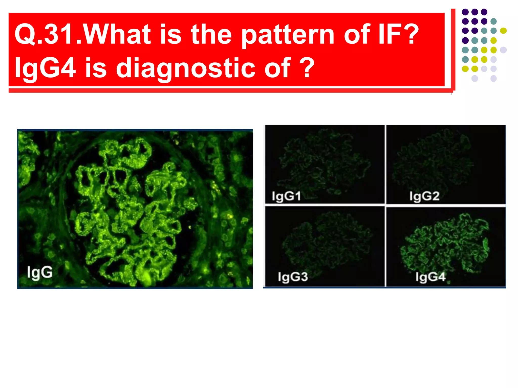 Q.31.What is the pattern of IF?
IgG4 is diagnostic of ?
 