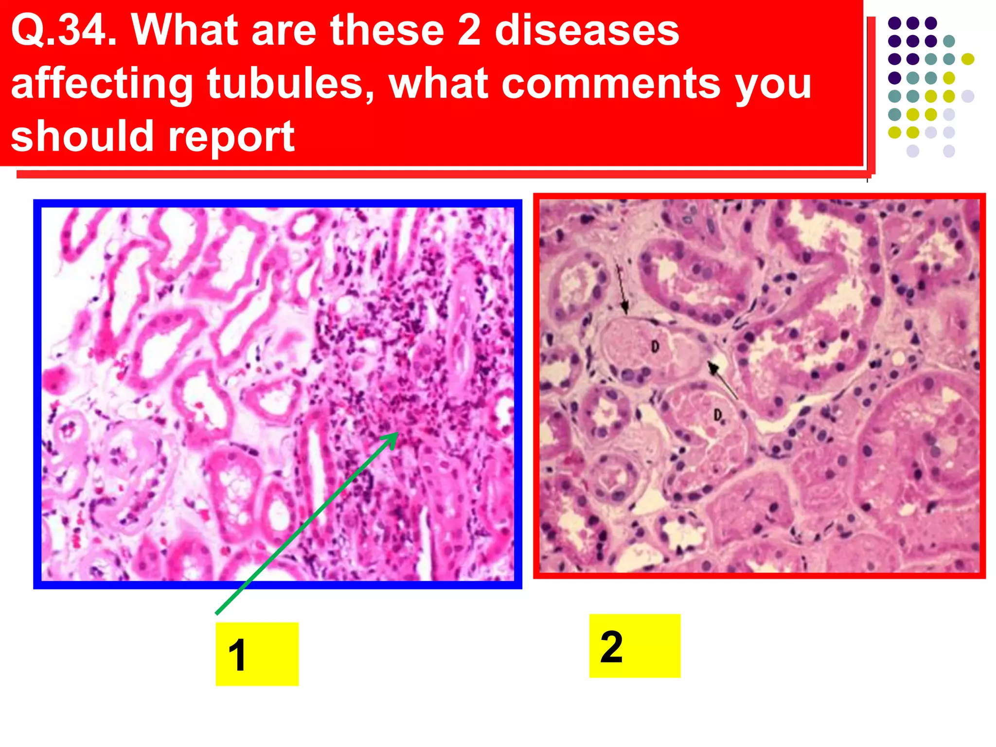 Q.34. What are these 2 diseases
affecting tubules, what comments you
should report
1 2
 