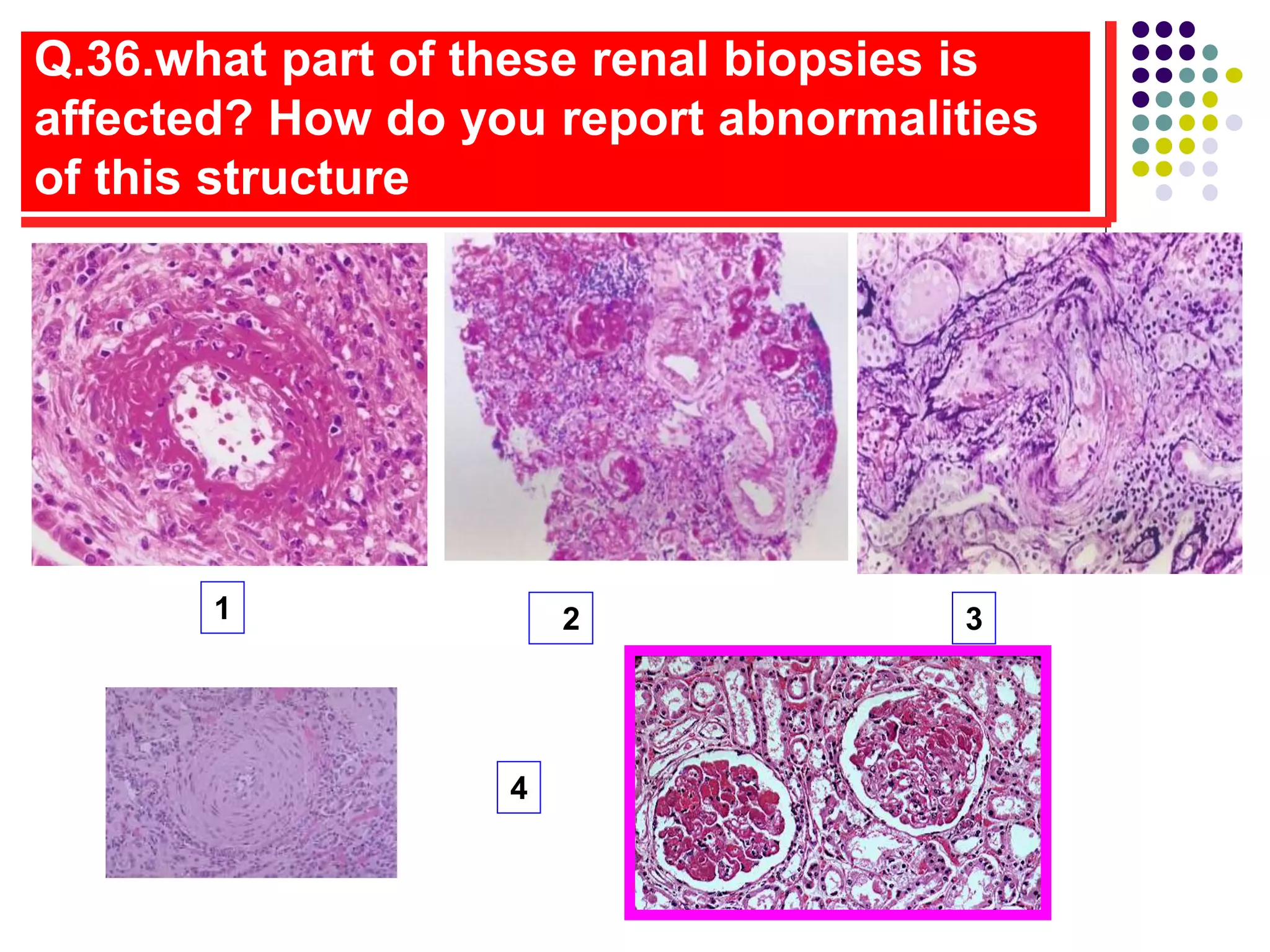 Q.36.what part of these renal biopsies is
affected? How do you report abnormalities
of this structure
1
4
3
2
 