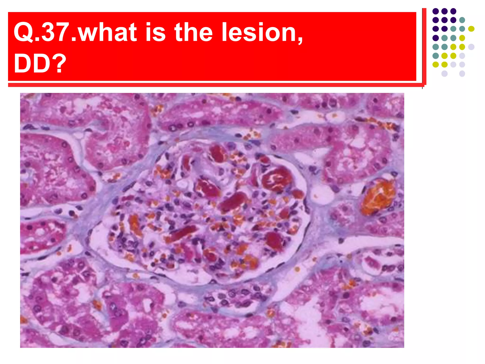 Q.37.what is the lesion,
DD?
 