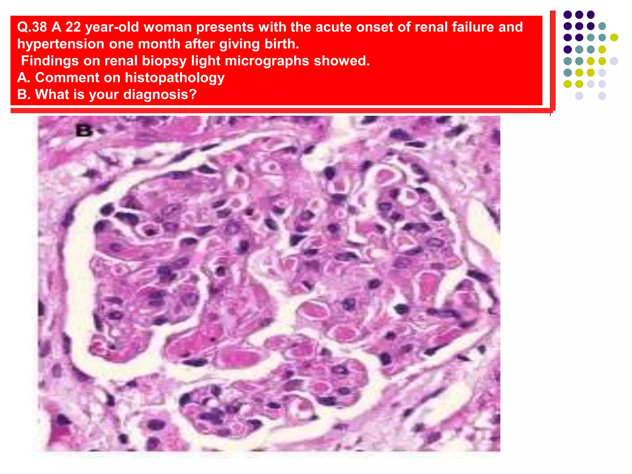 Q.38 A 22 year-old woman presents with the acute onset of renal failure and
hypertension one month after giving birth.
Findings on renal biopsy light micrographs showed.
A. Comment on histopathology
B. What is your diagnosis?
 