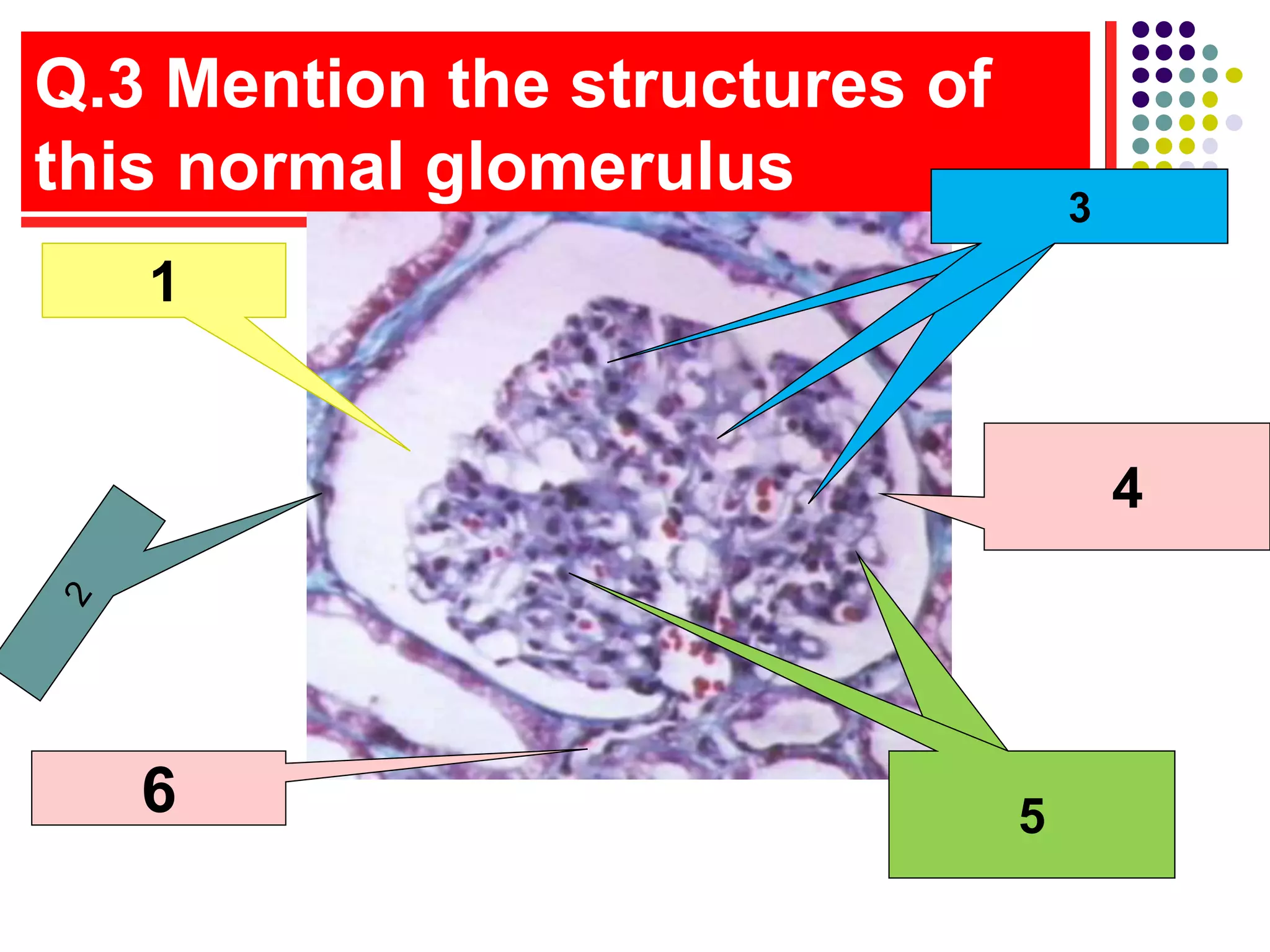 Q.3 Mention the structures of
this normal glomerulus Tufts of capillaries
6
4
1
3
5
 