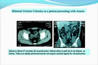 Bilateral Ureteric Calculus in a patient presenting with AnuriaBilateral Ureteric Calculus in a patient presenting with Anuria
Helical or Spiral CT provides 3D reconstruction. Helical refers to path the X ray follows on
Gantry. These are rapidly performed and do not require contrast agents for reconstruction.
 