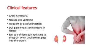 Clinical features
• Gross hematuria
• Nausea and vomiting
• Frequent or painful urination
• Dull pain when stone remains in
kidney
• Episode of flank pain radiating to
the groin when small stones pass
into the ureters
 