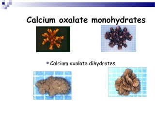 Calcium oxalate monohydrates
Calcium oxalate dihydrates
 