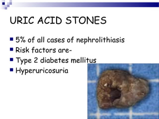 URIC ACID STONES
 5% of all cases of nephrolithiasis
 Risk factors are-
 Type 2 diabetes mellitus
 Hyperuricosuria
 