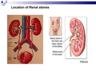 Location of Renal stones
 