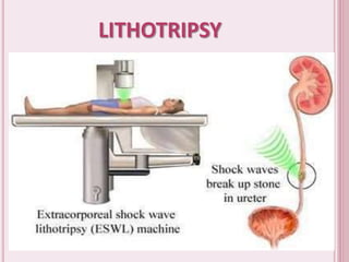 LITHOTRIPSY
 