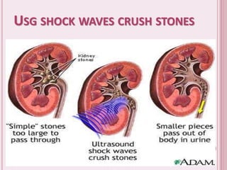 USG SHOCK WAVES CRUSH STONES
 