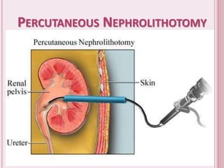 PERCUTANEOUS NEPHROLITHOTOMY
 