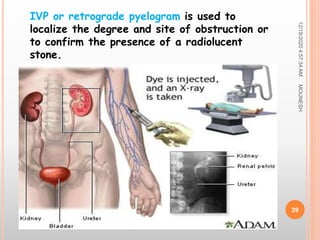 12/18/20204:57:34AM
29
IVP or retrograde pyelogram is used to
localize the degree and site of obstruction or
to confirm the presence of a radiolucent
stone.
MOUNESH
 