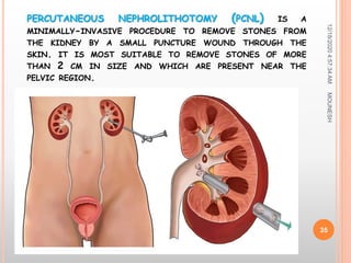PERCUTANEOUS NEPHROLITHOTOMY (PCNL) IS A
MINIMALLY-INVASIVE PROCEDURE TO REMOVE STONES FROM
THE KIDNEY BY A SMALL PUNCTURE WOUND THROUGH THE
SKIN. IT IS MOST SUITABLE TO REMOVE STONES OF MORE
THAN 2 CM IN SIZE AND WHICH ARE PRESENT NEAR THE
PELVIC REGION.
12/18/20204:57:34AM
35
MOUNESH
 