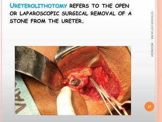 URETEROLITHOTOMY REFERS TO THE OPEN
OR LAPAROSCOPIC SURGICAL REMOVAL OF A
STONE FROM THE URETER.
12/18/20204:57:34AM
37
MOUNESH
 
