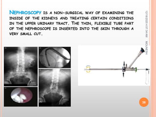 NEPHROSCOPY IS A NON-SURGICAL WAY OF EXAMINING THE
INSIDE OF THE KIDNEYS AND TREATING CERTAIN CONDITIONS
IN THE UPPER URINARY TRACT. THE THIN, FLEXIBLE TUBE PART
OF THE NEPHROSCOPE IS INSERTED INTO THE SKIN THROUGH A
VERY SMALL CUT.
12/18/20204:57:34AM
38
MOUNESH
 