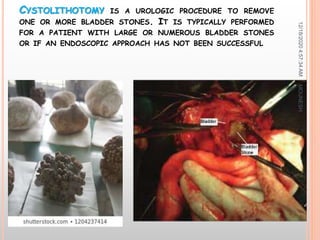 CYSTOLITHOTOMY IS A UROLOGIC PROCEDURE TO REMOVE
ONE OR MORE BLADDER STONES. IT IS TYPICALLY PERFORMED
FOR A PATIENT WITH LARGE OR NUMEROUS BLADDER STONES
OR IF AN ENDOSCOPIC APPROACH HAS NOT BEEN SUCCESSFUL
12/18/20204:57:34AM
39
MOUNESH
 