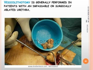 VESICOLITHOTOMY IS GENERALLY PERFORMED IN
PATIENTS WITH AN IMPASSABLE OR SURGICALLY
ABLATED URETHRA.
12/18/20204:57:34
AM
40
MOUNESH
 
