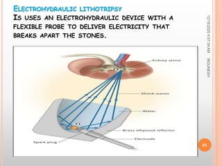ELECTROHYDRAULIC LITHOTRIPSY
IS USES AN ELECTROHYDRAULIC DEVICE WITH A
FLEXIBLE PROBE TO DELIVER ELECTRICITY THAT
BREAKS APART THE STONES.
12/18/20204:57:34AM
41
MOUNESH
 