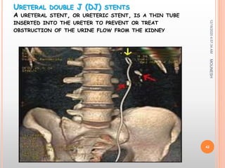 URETERAL DOUBLE J (DJ) STENTS
A URETERAL STENT, OR URETERIC STENT, IS A THIN TUBE
INSERTED INTO THE URETER TO PREVENT OR TREAT
OBSTRUCTION OF THE URINE FLOW FROM THE KIDNEY
12/18/20204:57:34AM
42
MOUNESH
 