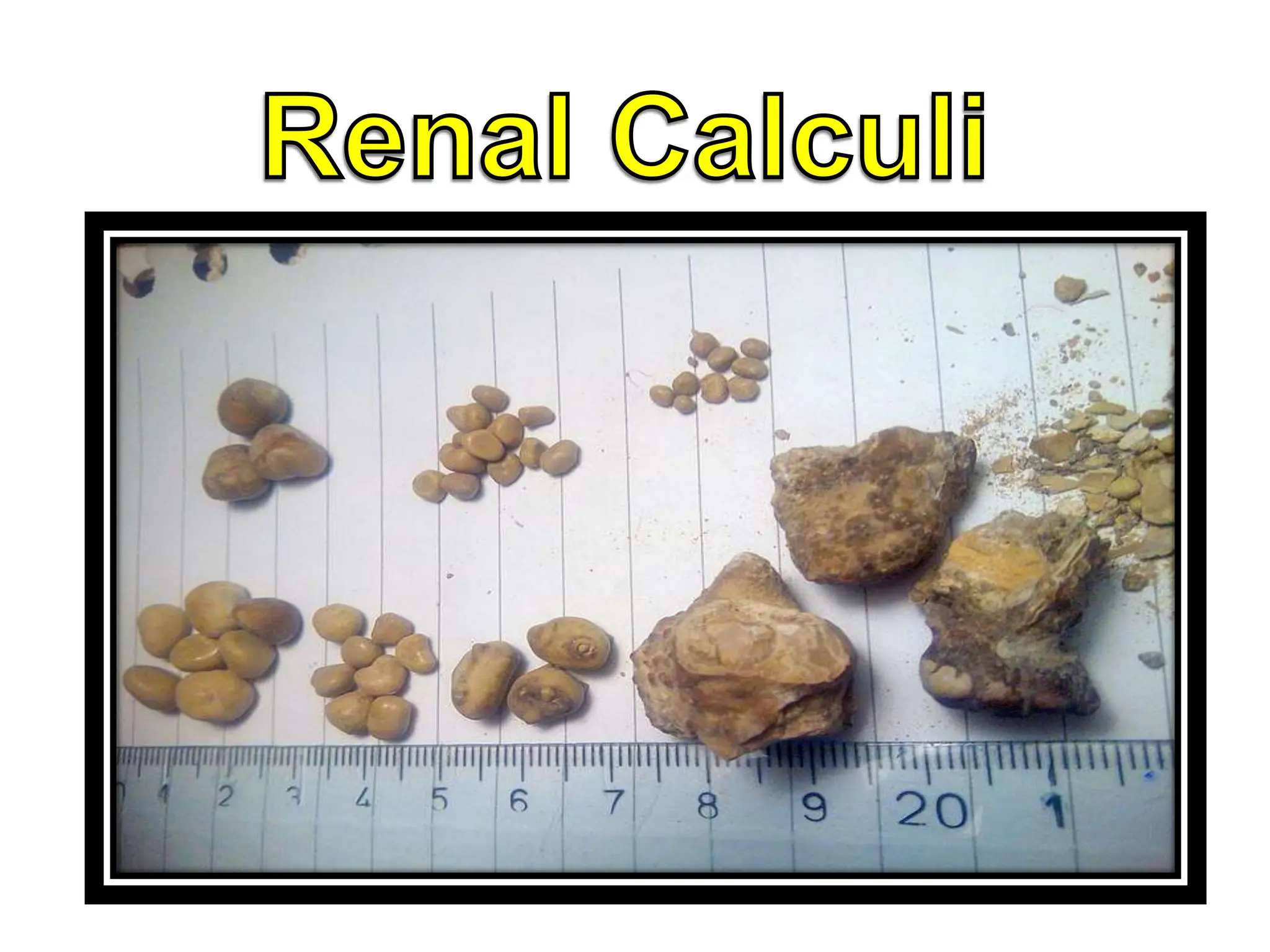 gabapentin renal calculi