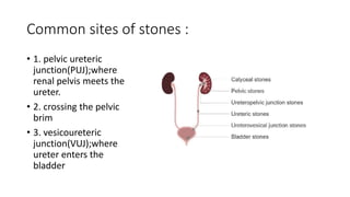 Common sites of stones :
• 1. pelvic ureteric
junction(PUJ);where
renal pelvis meets the
ureter.
• 2. crossing the pelvic
brim
• 3. vesicoureteric
junction(VUJ);where
ureter enters the
bladder
 