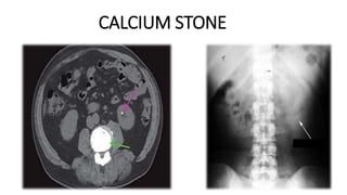 CALCIUM STONE
 