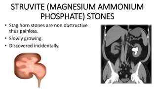STRUVITE (MAGNESIUM AMMONIUM
PHOSPHATE) STONES
• Stag horn stones are non obstructive
thus painless.
• Slowly growing.
• Discovered incidentally.
 