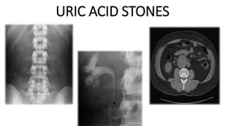 URIC ACID STONES
 