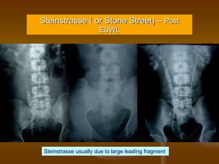 Steinstrasse ( or Stone Street) – Post
ESWL
Steinstrasse usually due to large leading fragment
 