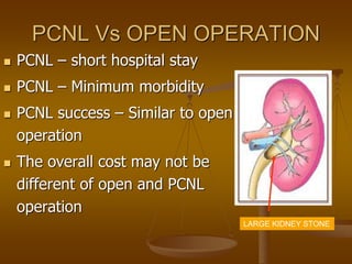 PCNL Vs OPEN OPERATION
 PCNL – short hospital stay
 PCNL – Minimum morbidity
 PCNL success – Similar to open
operation
 The overall cost may not be
different of open and PCNL
operation
LARGE KIDNEY STONE
 