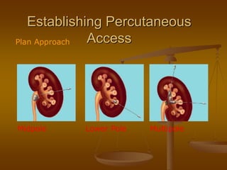 Establishing Percutaneous
AccessPlan Approach
Midpole Lower Pole Multipole
 
