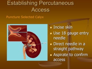 Establishing Percutaneous
Access
 Incise skin
 Use 18 gauge entry
needle
 Direct needle in a
straight pathway
 Aspirate to confirm
access
Puncture Selected Calyx
 