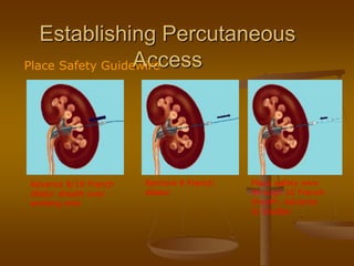 Establishing Percutaneous
AccessPlace Safety Guidewire
Advance 8/10 French
dilator sheath over
working wire
Remove 8 French
dilator
Place safety wire
through 10 French
sheath; Advance
to bladder
 