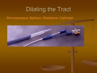 Dilating the Tract
Percutaneous Balloon Dilatation Catheter
 