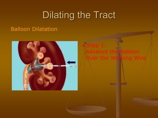 Dilating the Tract
Balloon Dilatation
• Step 1:
Advance the Balloon
Over the Working Wire
 