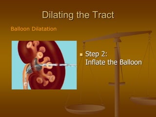 Dilating the Tract
 Step 2:
Inflate the Balloon
Balloon Dilatation
 