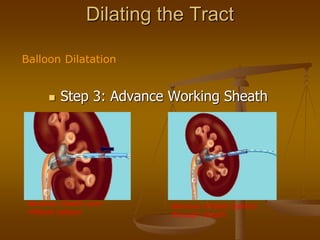 Dilating the Tract
 Step 3: Advance Working Sheath
Advance sheath over
inflated balloon
Remove inflated balloon
through sheath
Balloon Dilatation
 