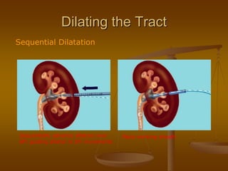 Dilating the Tract
Sequential Dilatation
Sequentially advance dilators over
8Fr guiding dilator in 2Fr increments
Place working sheath
 