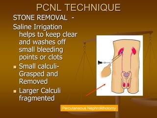 PCNL TECHNIQUE
STONE REMOVAL -
Saline Irrigation
helps to keep clear
and washes off
small bleeding
points or clots
 Small calculi-
Grasped and
Removed
 Larger Calculi
fragmented
Percutaneous Nephrolithotomy
 
