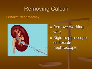Removing Calculi
 Remove working
wire
 Rigid nephroscope
or flexible
nephroscope
Perform Nephroscopy
 