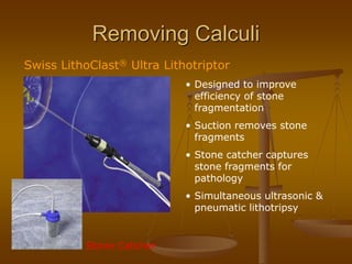 Removing Calculi
Swiss LithoClast® Ultra Lithotriptor
• Designed to improve
efficiency of stone
fragmentation
• Suction removes stone
fragments
• Stone catcher captures
stone fragments for
pathology
• Simultaneous ultrasonic &
pneumatic lithotripsy
Stone Catcher
 