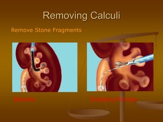 Removing Calculi
Remove Stone Fragments
Baskets Grasping Forceps
 