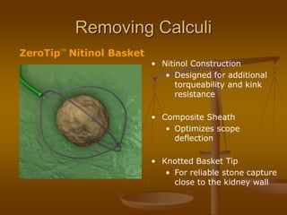 ZeroTipTM
Nitinol Basket
Removing Calculi
• Nitinol Construction
• Designed for additional
torqueability and kink
resistance
• Composite Sheath
• Optimizes scope
deflection
• Knotted Basket Tip
• For reliable stone capture
close to the kidney wall
 