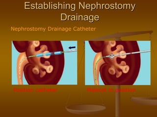 Establishing Nephrostomy
Drainage
Nephrostomy Drainage Catheter
Position catheter Malecot in position
 