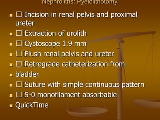 Nephroliths: Pyelolithotomy
 􀂄 Incision in renal pelvis and proximal
ureter
 􀂄 Extraction of urolith
 􀂄 Cystoscope 1.9 mm
 􀂄 Flush renal pelvis and ureter
 􀂄 Retrograde catheterization from
 bladder
 􀂄 Suture with simple continuous pattern
 􀂄 5-0 monofilament absorbable
 QuickTime
 