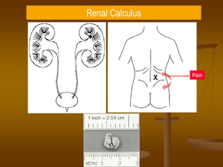 Renal Calculus
Pain
 