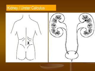 Kidney / Ureter Calculus
 